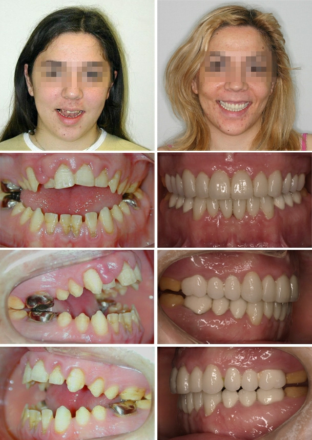 Casos de ortodoncia complejos resueltos en Vela y Lasagabaster