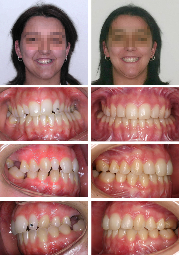 Casos resueltos con cirugía en Vela y Lasagabaster, ortodoncia en Vitoria y Logroño