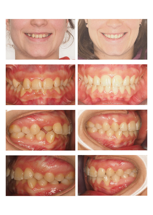 Caso resuelto con ortodoncia lingual en Vela y Lasagabaster, ortodoncia en Vitoria y Logroño