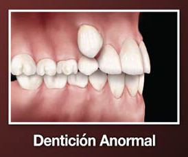 denticion anormal 10R