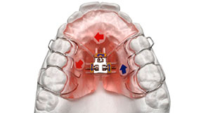 Aparatos removibles en Vela y Lasagabaster, ortodoncia en Vitoria y Logroño